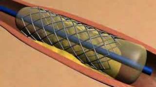 Stent Animation [upl. by Imef]