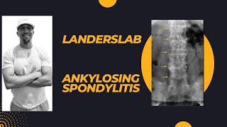 Ankylosing Spondylitis [upl. by Evanthe979]