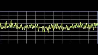 Asperger Syndrome  Rife Frequencies [upl. by Uase553]