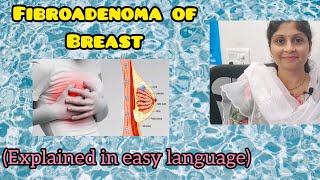 Fibroadenoma of Breast explained in simple language  Female Health  Treatment [upl. by Mistrot833]