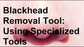 Blackhead Removal Tool Using Specialized Tools Like a Comedone Extractor [upl. by Eninnaj]