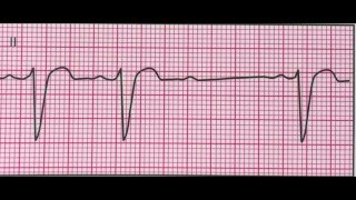 Bloc auriculoventriculaire de 2ème degré Mobitz type 2 [upl. by Aleyam]