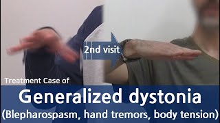 Generalized Dystonia  Cervical dystonia Dysphonia Oromandibular dystonia  전신 디스토니아 치료사례  근긴장이상증 [upl. by Eldnek]