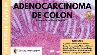 ADENOCARCINOMA DE COLON INTRODUCCIÓN PÓLIPOS Y VÍA SUPRESORA [upl. by Corilla]