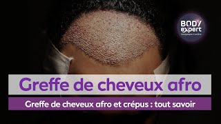 GREFFE DE CHEVEUX TURQUIE  Greffe de cheveux afro et crépus  tout savoir  BODYEXPERT [upl. by Pegg]