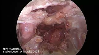 Module 10 Endoscopic Transclival approach and review of anatomy [upl. by Llewellyn]