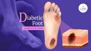 Diabetic Foot Causes Symptoms Treatment and Care  CARE Hospitals [upl. by Moreville966]