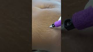 Stretch Marks Inkless Removal Boleyn Treatment Los Angeles 🌍 shorts [upl. by Gayle]