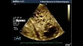 TheEchoWeb  Spongiform Cardiomyopathy [upl. by Battista]