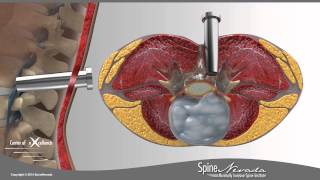 Lumbar Microdiscectomy  Spine Center Northern Nevada Northern California  Spine Surgery [upl. by Rains]