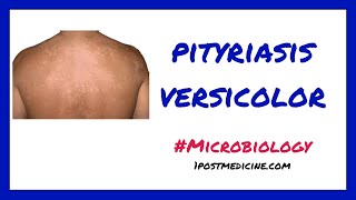 Pityriasis Versicolor  Microbiology [upl. by Susann]