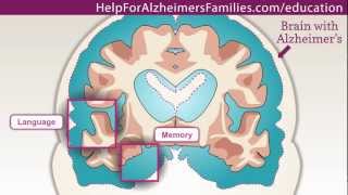 Alzheimers Effect on the Brain [upl. by Natale]