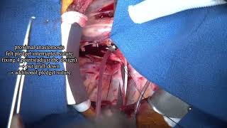 kommerells diverticulum 5 subtitled edition [upl. by Cecil964]