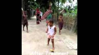 Walk For Life Clubfoot Bangladesh Happy StoryUrmi [upl. by Sivehc]