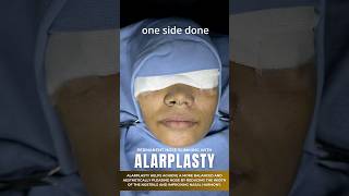 Achieve Permanent Nose Slimming with Alarplasty  Sarayu Clinics beauty nose [upl. by Ariamo]