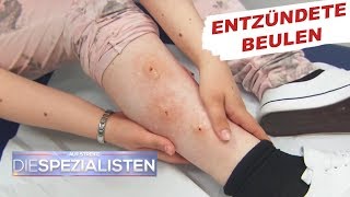 Beulen an den Beinen Parasitenbefall  Auf Streife  Die Spezialisten  SAT1 TV [upl. by Enram715]