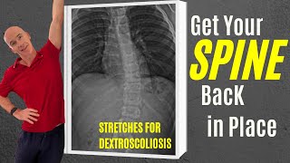 3 Corrective Exercises to Straighten Dextroscoliosis scoliosistreatment scoliosistherapy [upl. by Irmine]