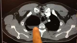 Clinical Case Pulmonary Abscess [upl. by Durman]