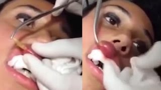 Doctor Removes A Live Maggot From Womans Lip On Video [upl. by Esenahs]