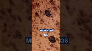 MELANOMA cáncerdepiel salud aprender undato [upl. by Theodosia]