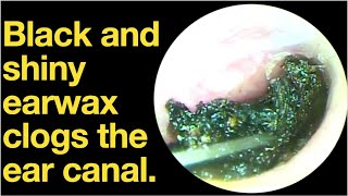 Black and shiny earwax clogs the ear canalear wax removal  ear cleaning  ASMR  relaxation [upl. by Xino]