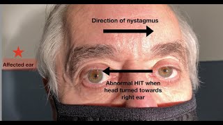 What ear does the nystagmus in vestibular neuritis beat towards [upl. by Akcirret350]