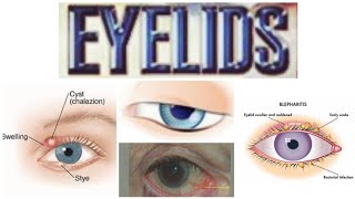 Eyelids 6 Major Topic Entropion [upl. by Abdu]