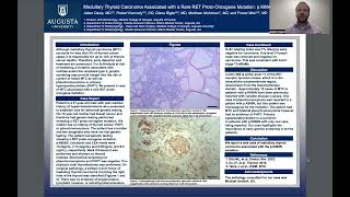 Medullary Thyroid Carcinoma Associated with a Rare RET ProtoOncogene Mutation pK666N [upl. by Trici516]