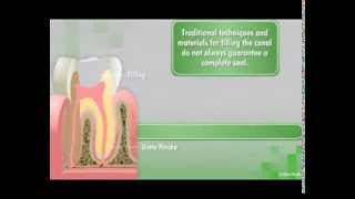 GuttaFlow2 D Root Canal Filling System [upl. by Tshombe]