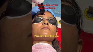 Fractional laser resurfacing of acne scars by erbium YAG laser acnescars skincare shortsfeed [upl. by Atinreb]