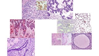 Lung adenocarcinoma histology [upl. by Leirvag973]