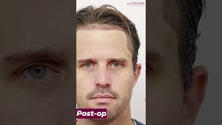 Former England Cricketer Hair Transplant Before and after Results at Eugenix Hair Sciences Clinic [upl. by Chaddie]