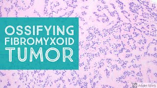 Ossifying Fibromyxoid Tumor OFMT of Soft Parts [upl. by Morissa]