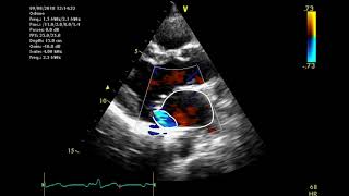 Echocardiographic assessment of the mitral valve [upl. by Etnuhs626]