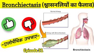 Bronchiectasis in hindi श्वासनलियों का फुल कर जकड़ जाना क्या है कारण लक्षण और उपचार  Episode 31 [upl. by Ettenna]