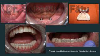 Proteza pe implant dentar  Dr Fatu [upl. by Narhem891]