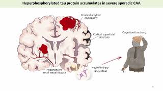 Cerebral Tau Pathology in Cerebral Amyloid Angiopathy [upl. by Salb]