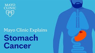 Mayo Clinic explains stomach cancer [upl. by Ellery]