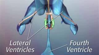 Anatomy of Hypothalamic Hamartoma [upl. by Eirroc]