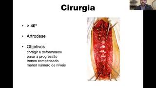 Deformidades da coluna vertebral [upl. by Shawna]