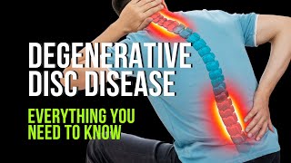 Degenerative Disc Disease  Everything You Need to Know [upl. by Gabey]