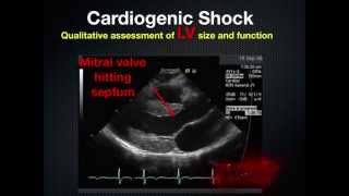 RUSH Rapid Ultrasound in Shock [upl. by Nierman38]