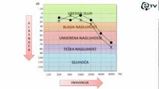 Kako pročitati audiogram [upl. by Alekahs560]