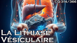 La Lithiase Vésiculaire ou Pierre à la Vésicule  CQ314 [upl. by Alenairam]