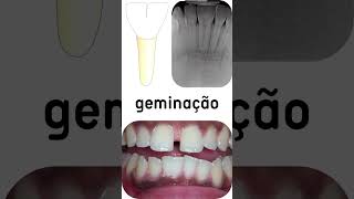 Geminação e fusão dentária [upl. by Hellah]