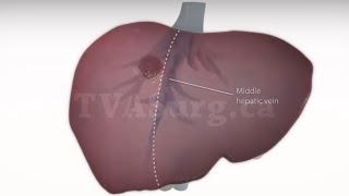 Standard right hepatectomy [upl. by Acined]