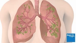 How chronic obstructive pulmonary disease COPD develops  Bupa Health [upl. by Friedlander]