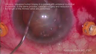 Vitreous aqueous humor biopsy in a patient with unilateral multifocal choroiditis In the same pro [upl. by Ahsatel]