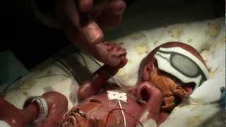 24 week premature baby  Tobys journey [upl. by Jacie]