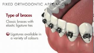 MalocclusionFixed Orthodontic AppliancesBraces [upl. by Cain]